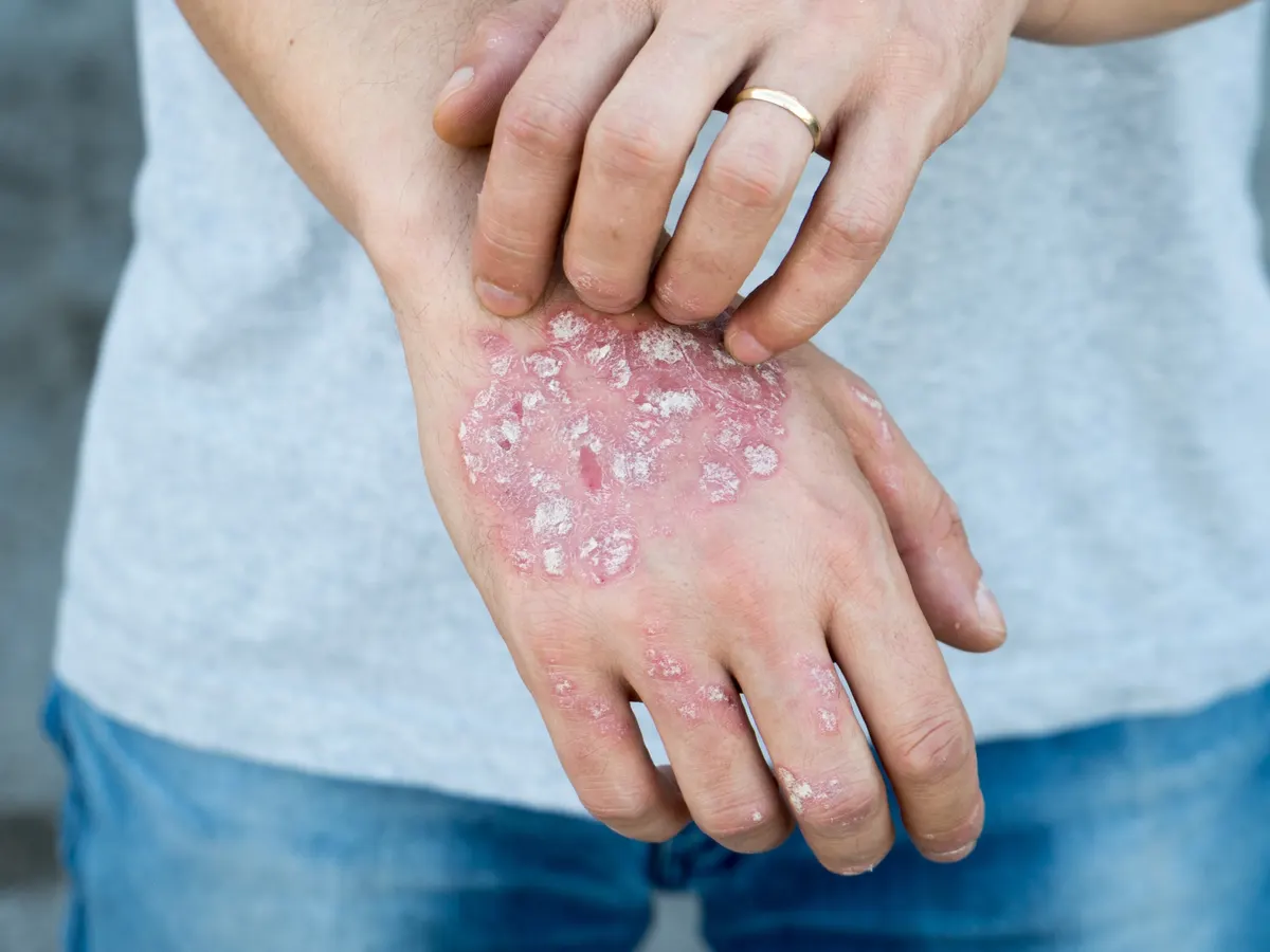 person itching psoriasis on the back of their hand