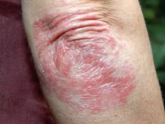 Psoriasis on elbow