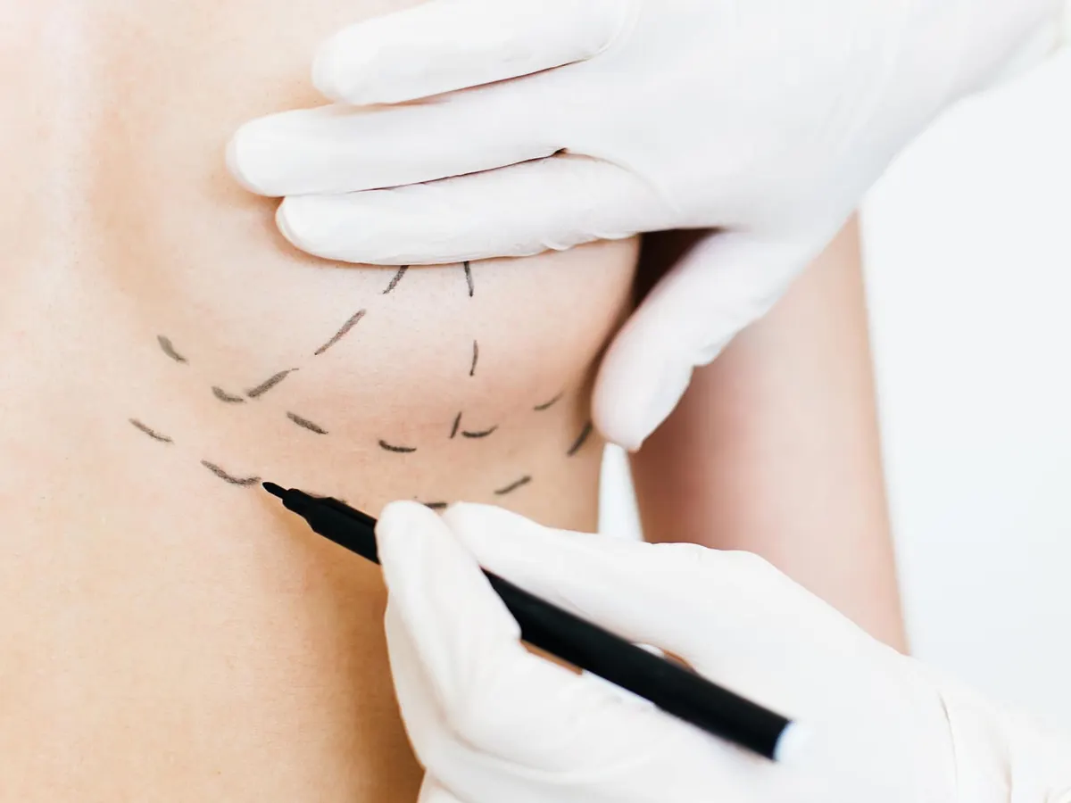 Gloved hands draw dotted guide lines on the skin beneath a breast with a marker