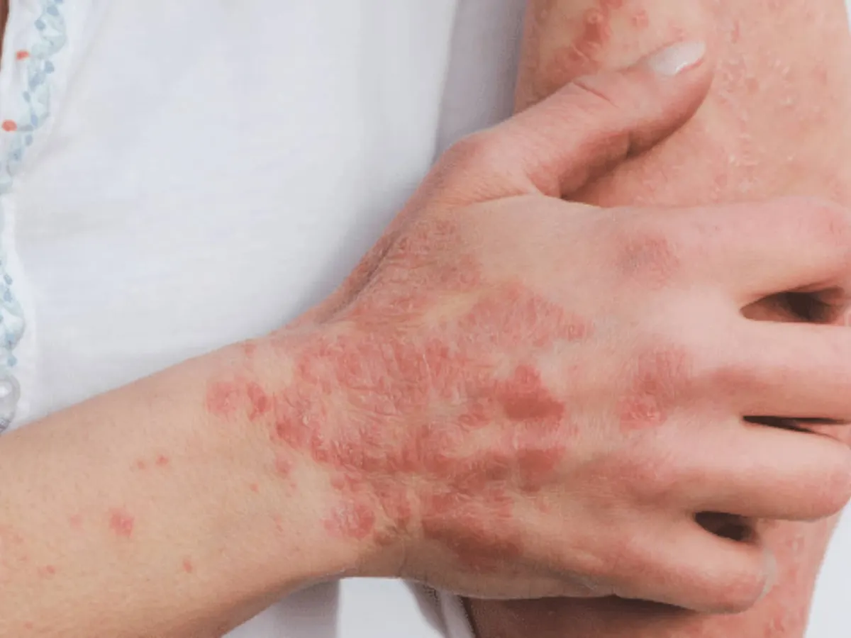 Red, scaly patches of skin on the back of a hand and wrist