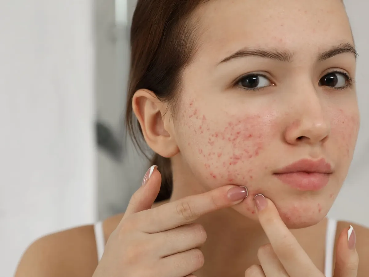 A young woman with red spots across her cheeks touches her chin