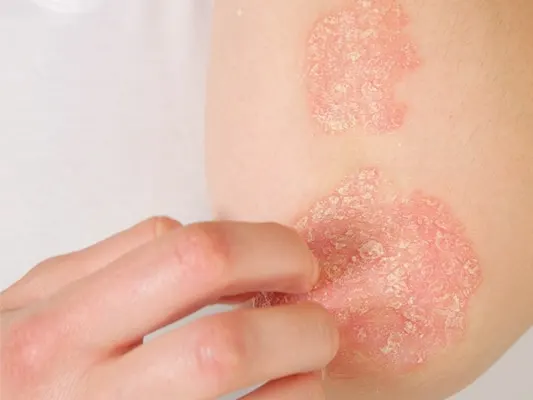 Eczema Worse in the Winter