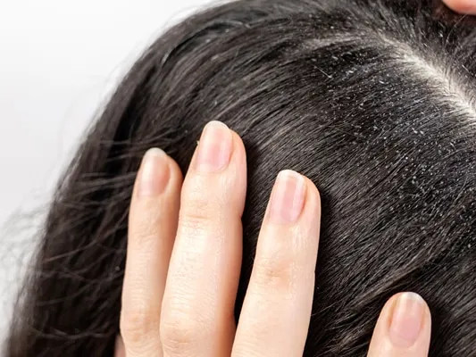 woman holds her head with her hands, showing a parting of dark hair with dandruff