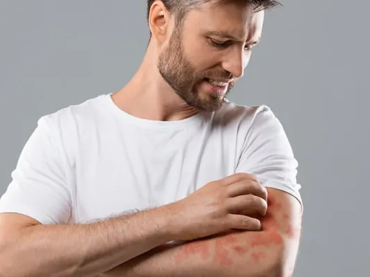 Annoyed middle-aged man in white t-shirt scratching itch on his arm