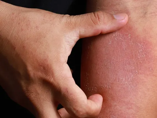 Dermatitis on skin ill allergic rash dermatitis eczema