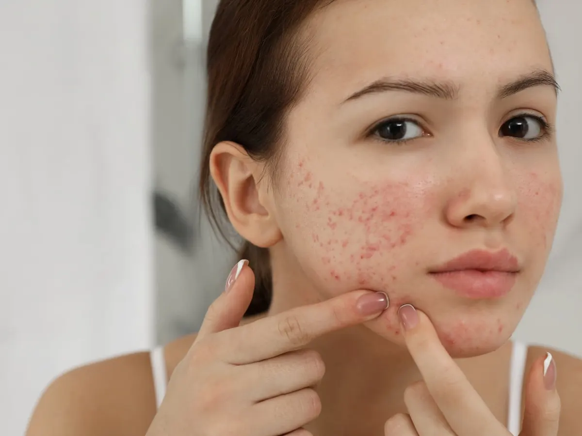 A young woman with red spots across her cheeks touches her chin