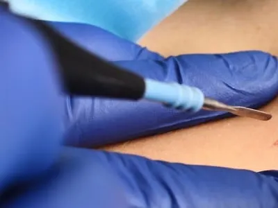 dermatologist surgeon removes a neoplasm - a mole or nevus from the patient's abdomen
