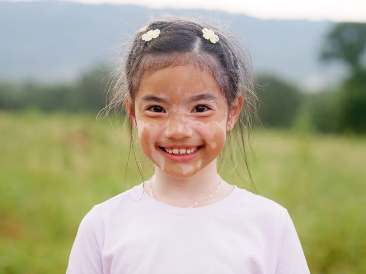 A smiling young girl in a field, with patches of lighter skin around her eyes and mouth