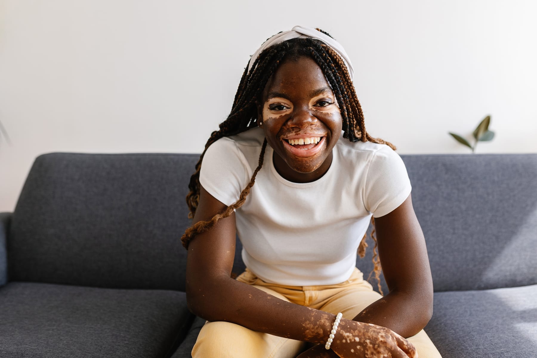 A smiling young woman with braids and patches of lighter skin on her face and hands sits on a sofa