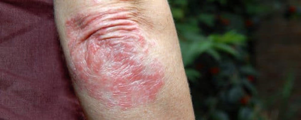 Psoriasis on elbow