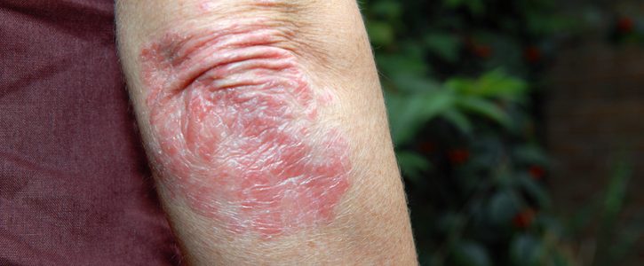 Psoriasis on elbow