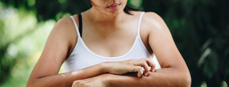Psoriasis Flare-up