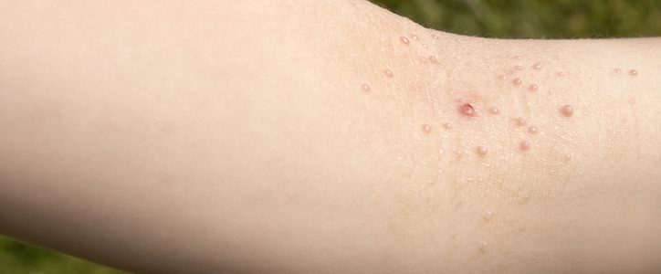 Molluscum Contagiosum