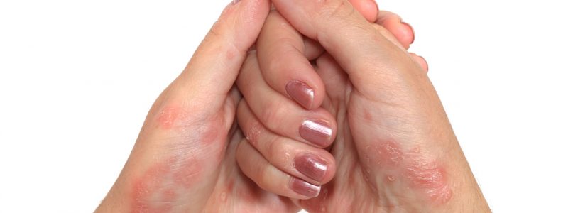 eczema treatment