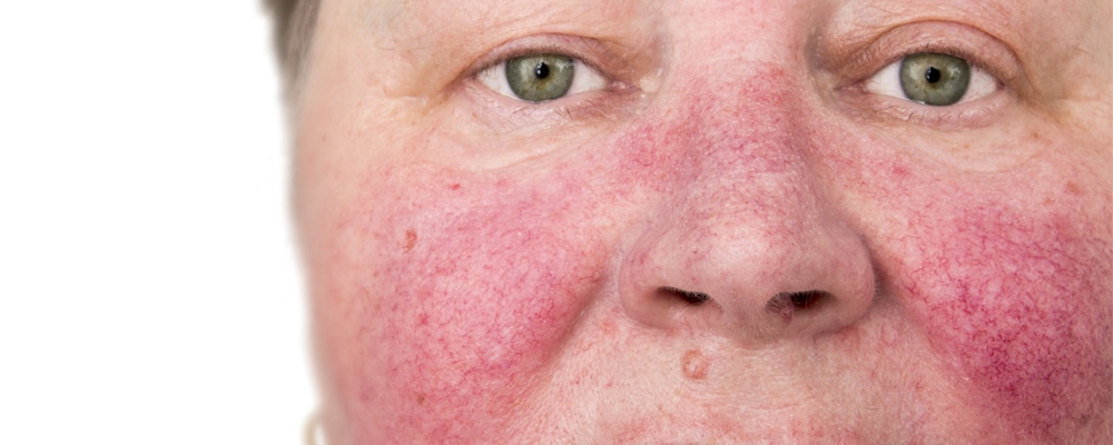 An elderly woman with skin condition rosacea