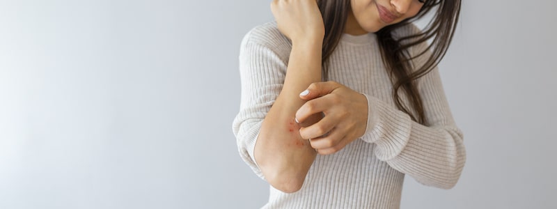 young woman scratching Prurigo Nodularis lumps on arm