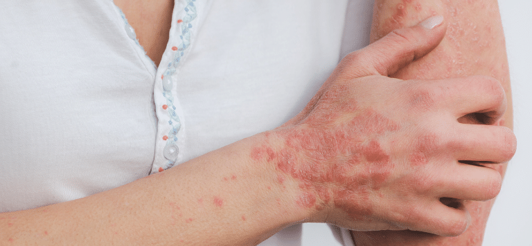 psoriasis