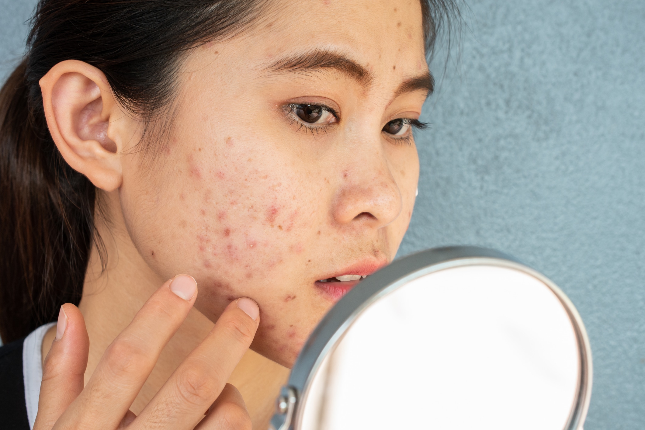 Conceptual shot of Acne & Problem Skin on female face.