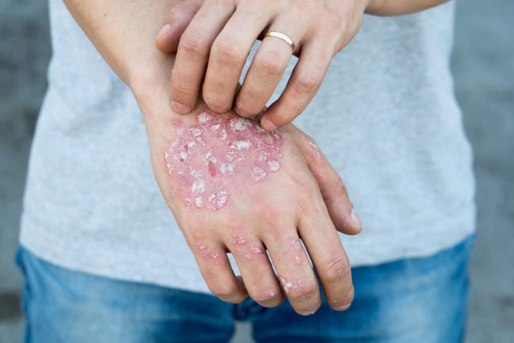 man itching a really bad case of psoriasis on his hand