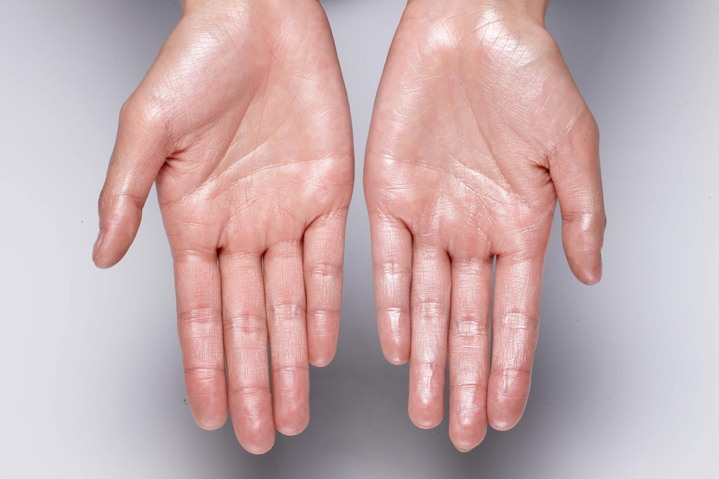 sweaty hands due to hyperhidrosis