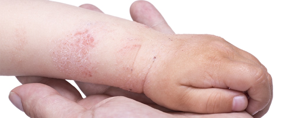 Eczema on the skin of the kid's hand