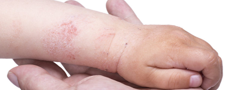 Eczema on the skin of the kid's hand