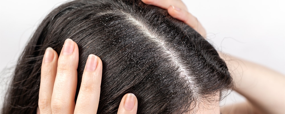 woman holds her head with her hands, showing a parting of dark hair with dandruff