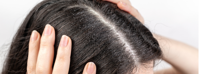 woman holds her head with her hands, showing a parting of dark hair with dandruff