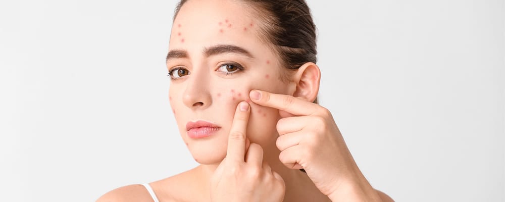 woman with acne problem squishing pimples