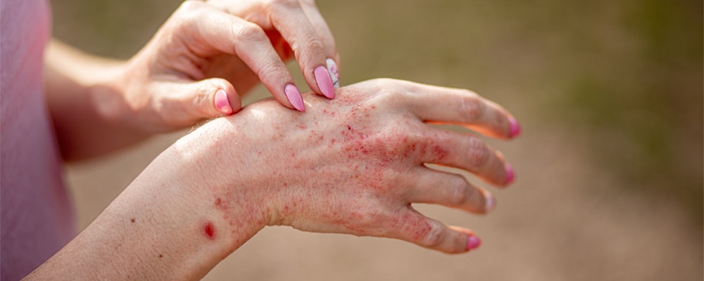 Close up dermatitis on skin ill allergic rash eczema skin of patient
