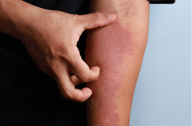 Dermatitis on skin ill allergic rash dermatitis eczema