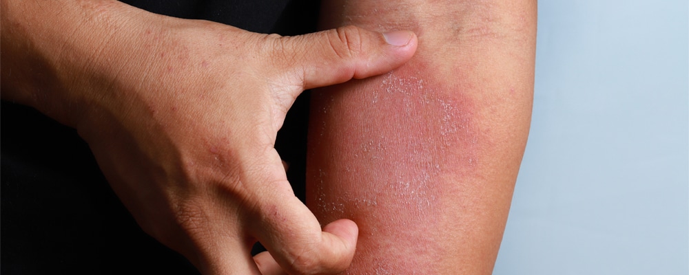 Dermatitis on skin ill allergic rash dermatitis eczema