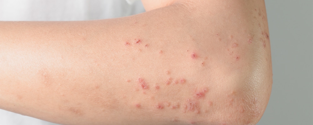 allergic to chemicals and Itchy skin lesions from allergies