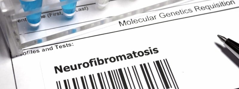 Neurofibromatosis Type 1 NF1 with Cutaneous Neurofibromas