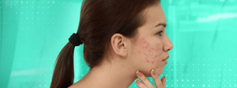 Papulopustular Rosacea