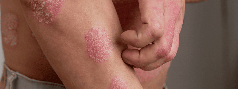 Psoriasis