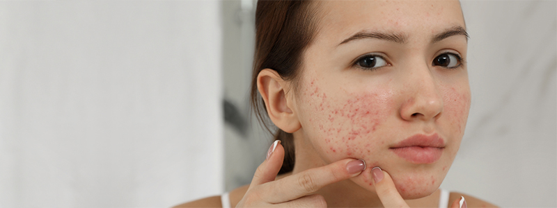 young woman with acne on cheek looking in mirror