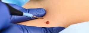 dermatologist surgeon removes a neoplasm - a mole or nevus from the patient's abdomen