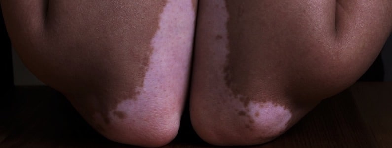  Vitiligo