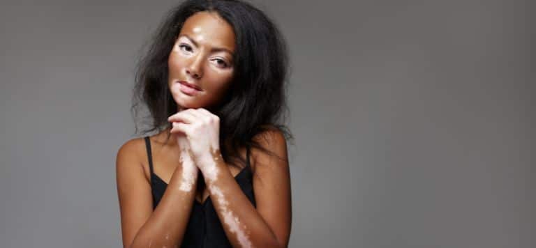 vitiligo