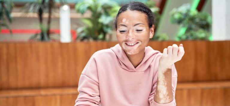 young woman in pink hoodie with varying levels of pigmentation, or vitiligo