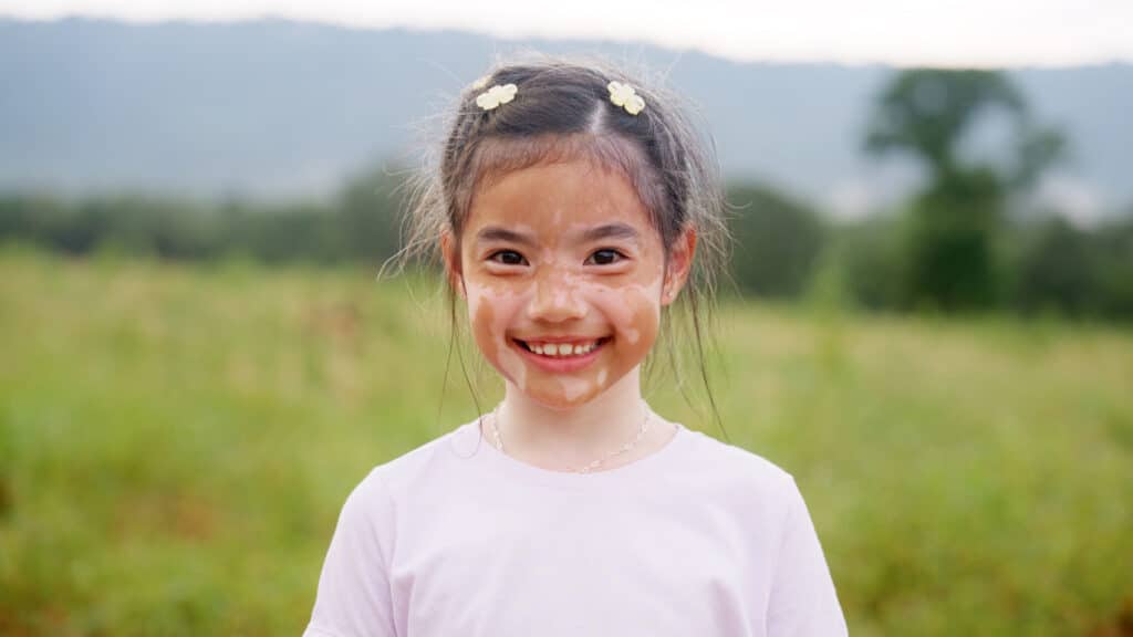 Little cute alpha young albino vitiligo small school girl relax smile look at camera. Real melanin face body skin care hair color of asia people gen z kid in self love happy proud of diverse beauty.