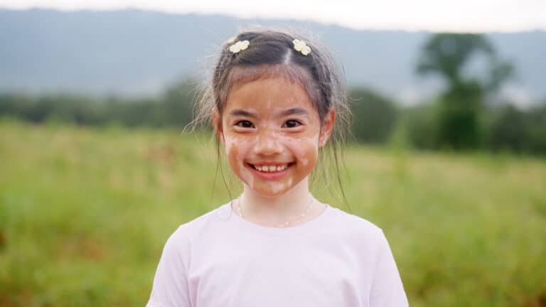 Little cute alpha young albino vitiligo small school girl relax smile look at camera. Real melanin face body skin care hair color of asia people gen z kid in self love happy proud of diverse beauty.