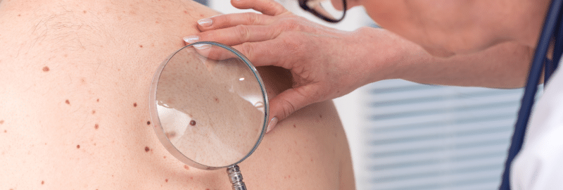 Dermatology Clinical Trials for Melanoma Treatment