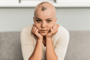 alopecia areata