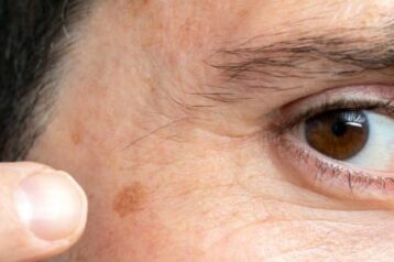 detail of facial melanoma on middle aged man picture id1214692943 e1